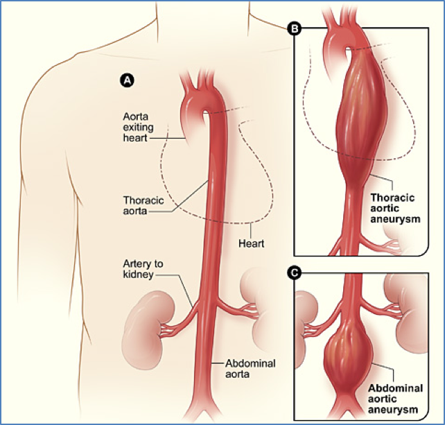 THORACIC AORTIC ANEURYSMS