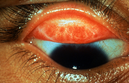 trachoma: Trachomatous Scarring