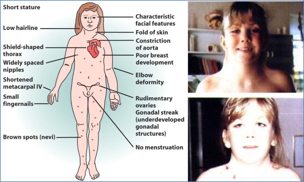 TURNER’S SYNDROME