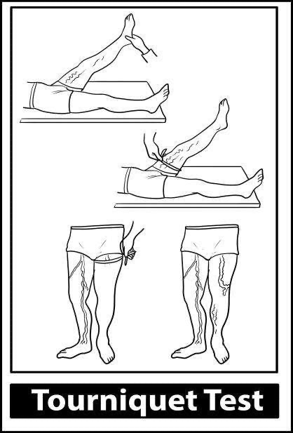 Tourniquet test