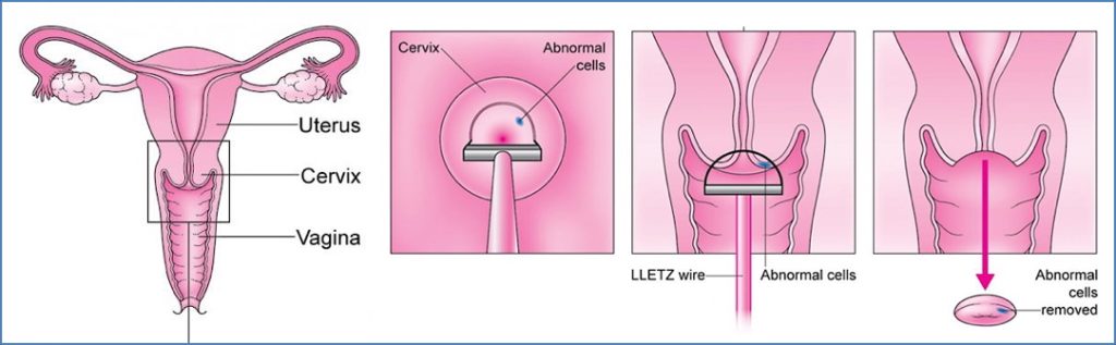 cervical cancers: Treatment
