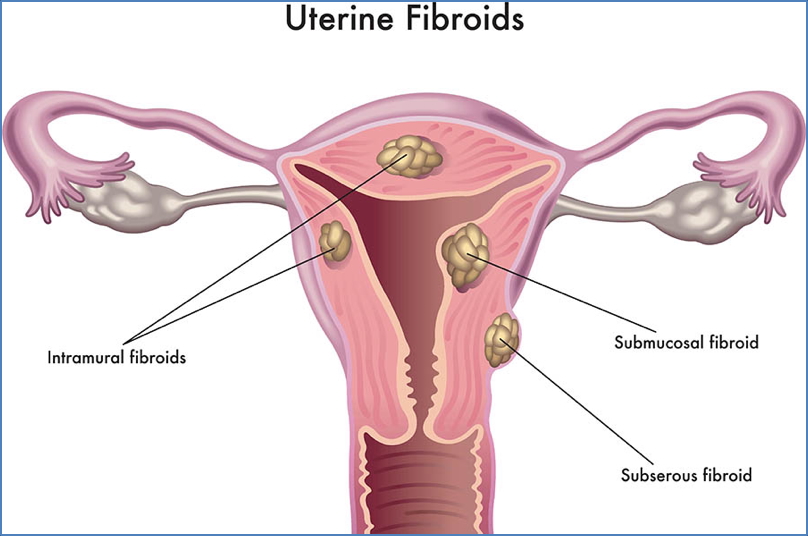 UTERINE FIBROIDS