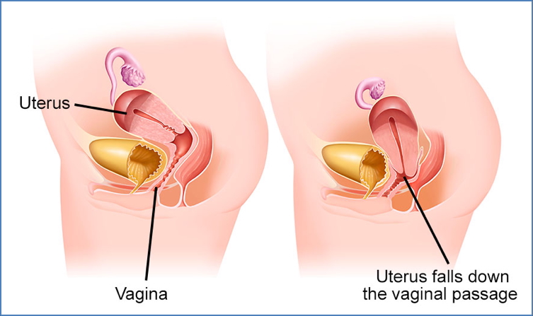 pelvic organ prolapse: UTEROCERVICAL PROLAPSE