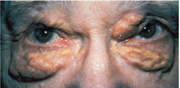 Xanthelasma