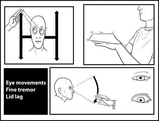 eye movements, tremor, lid lag