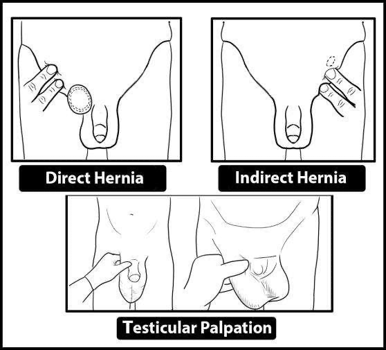 hernia types