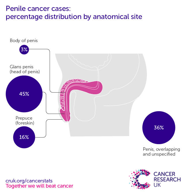 Penile cancer anatomical sites